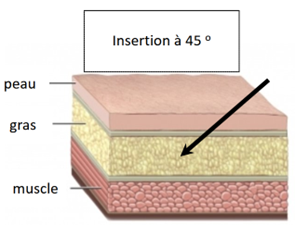 Insertion de l'aiguille à 45 degrés.