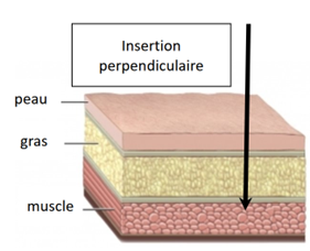 Insertion perpendiculaire pour une injection intramusculaire